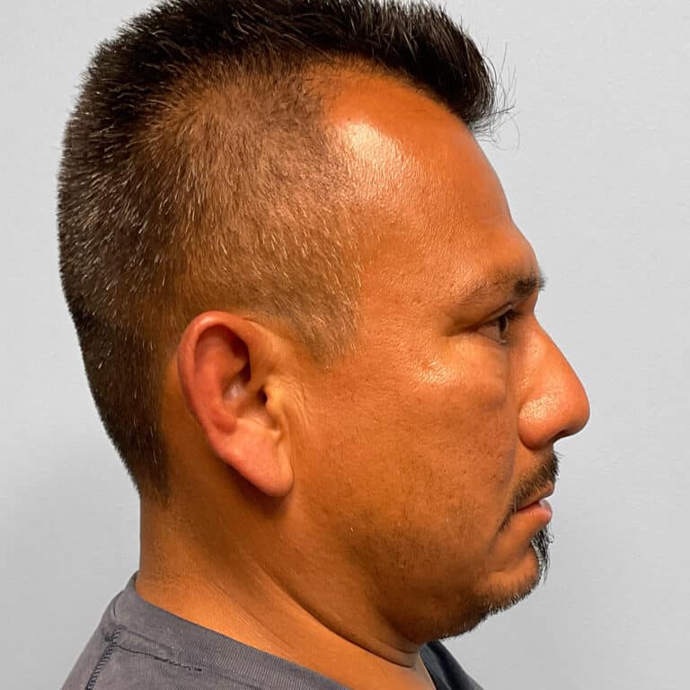 After Image: Upper & Lower Blepharoplasty – Dr. Tucker - right-side