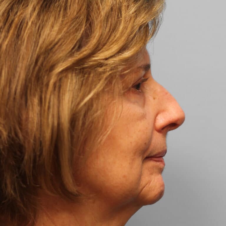 After Image: Upper & Lower Blepharoplasty – Dr. Tucker - right-side