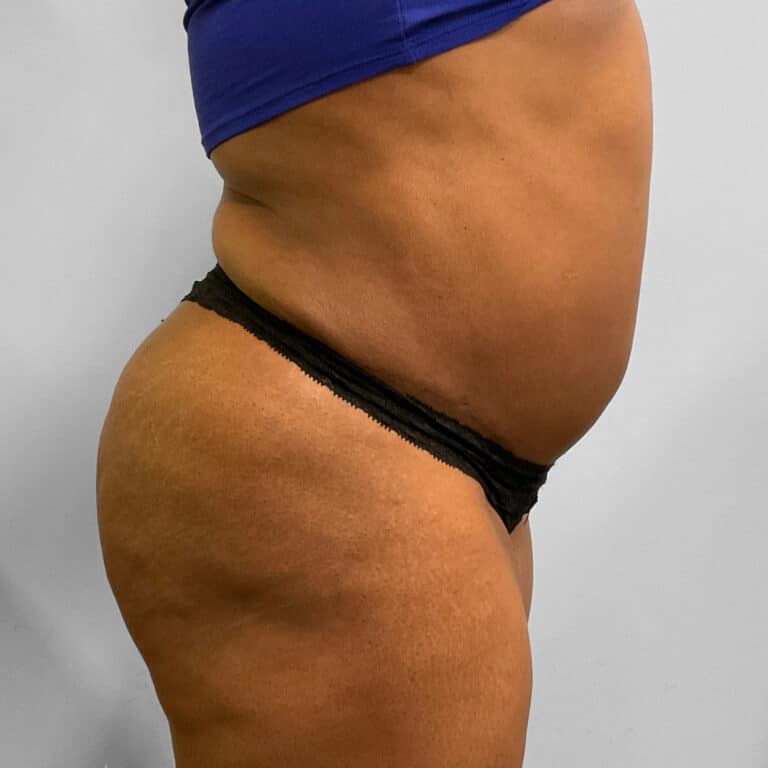 After Image: BBL, Abdominoplasty & Lipo – Dr. Tucker - right-side