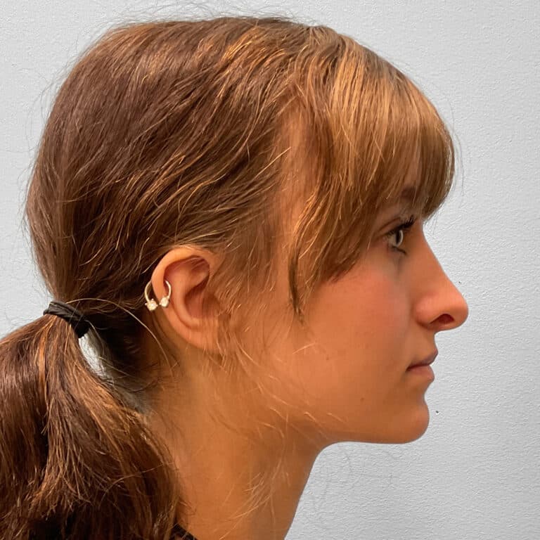 After Image: Rhinoplasty – Dr. Tucker - right-side