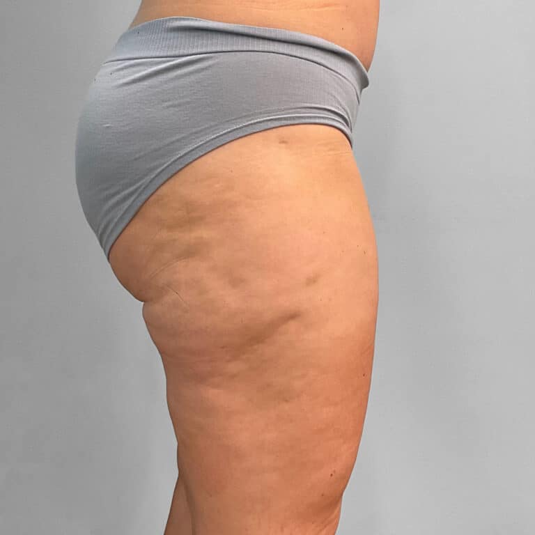 After Image: Emsculpt Neo – Jessica - right-side