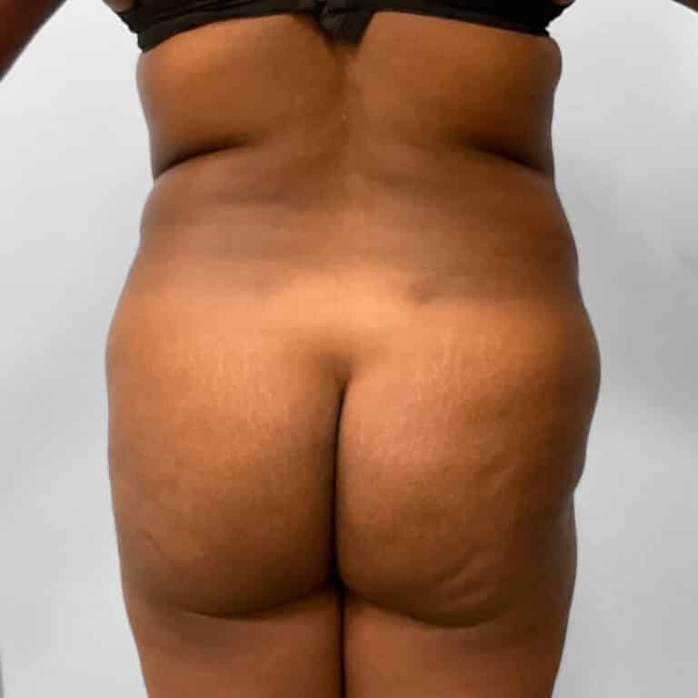 Before Image: BBL, Abdominoplasty & Lipo – Dr. Tucker - back