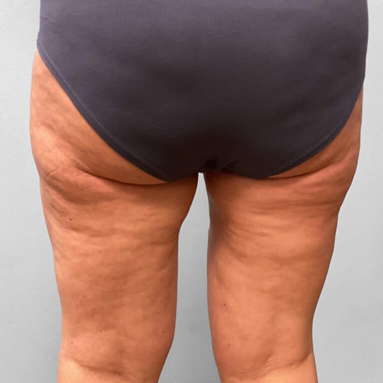 Before Image: Emsculpt Neo – Jessica - back