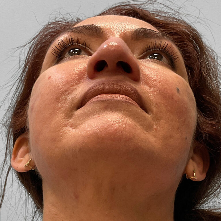 Before Image: Rhinoplasty – Dr. Tucker - other