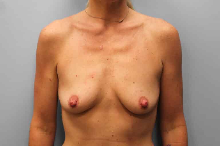 Before Image: Breast Augmentation – Dr. Tucker - front