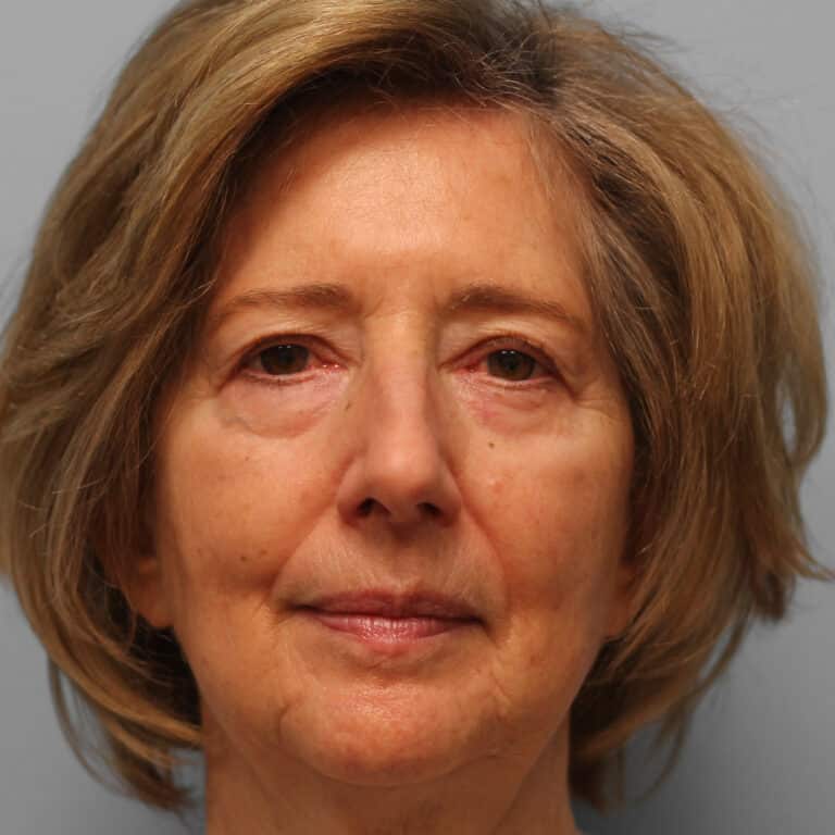 Before Image: Upper & Lower Blepharoplasty – Dr. Tucker - front