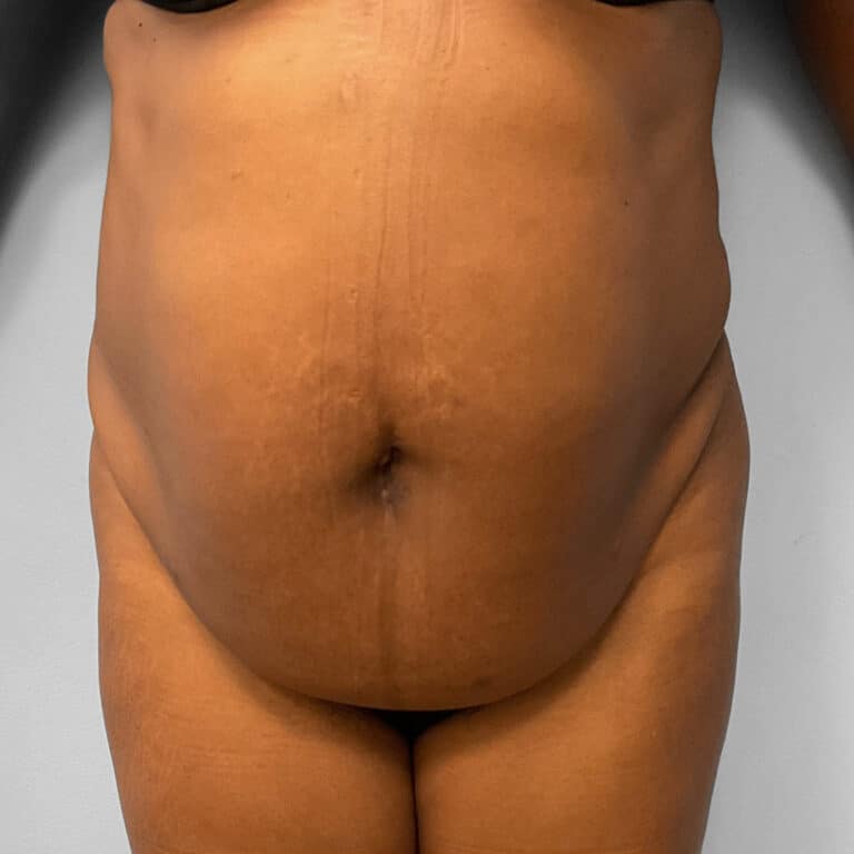 Before Image: BBL, Abdominoplasty & Lipo – Dr. Tucker - front