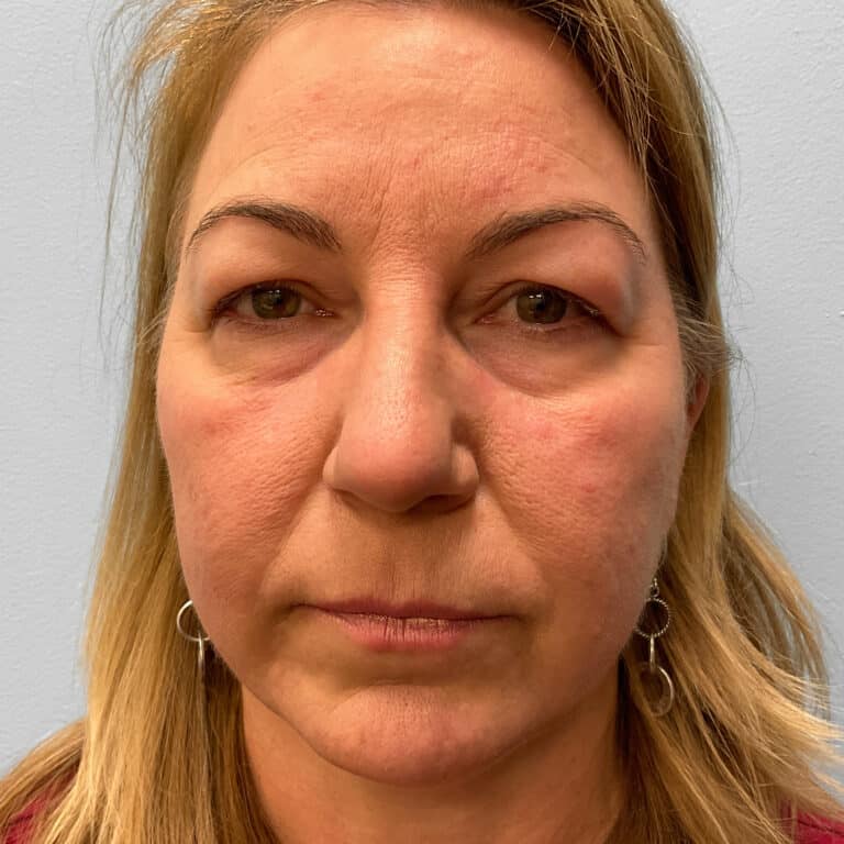 Before Image: Upper and Lower Blepharoplasty – Dr. Tucker - front