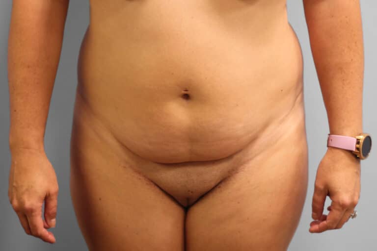 Before Image: Tummy Tuck – Dr. Tucker - front