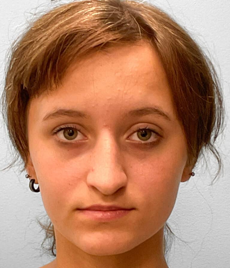 Before Image: Rhinoplasty – Dr. Tucker - front