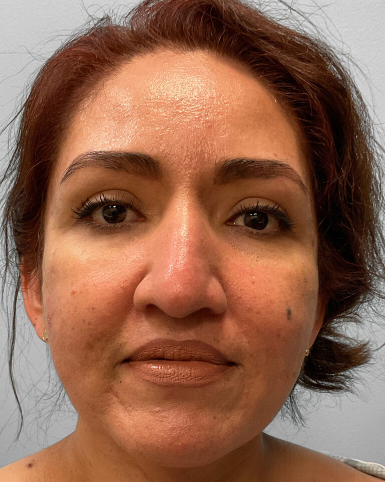 Before Image: Rhinoplasty – Dr. Tucker - front