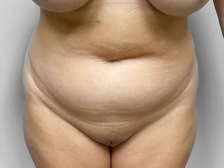 Before Image: Tummy Tuck & 360 Lipo – Dr. Tucker - front