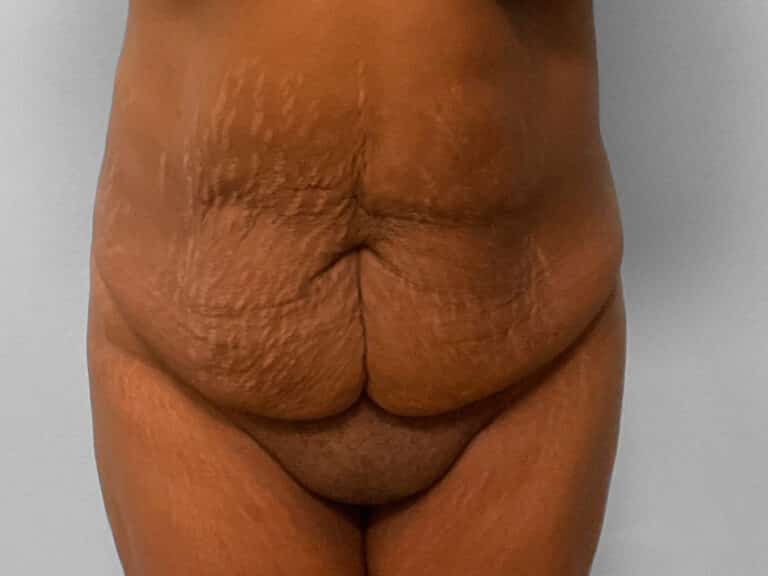 Before Image: Tummy Tuck & Lipo – Dr. Tucker - front