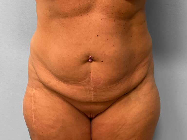 Before Image: Tummy Tuck & Lipo – Dr. Tucker - front