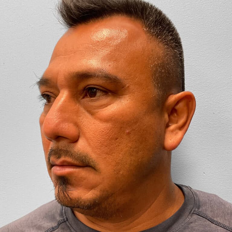 Before Image: Upper & Lower Blepharoplasty – Dr. Tucker - left-front-oblique