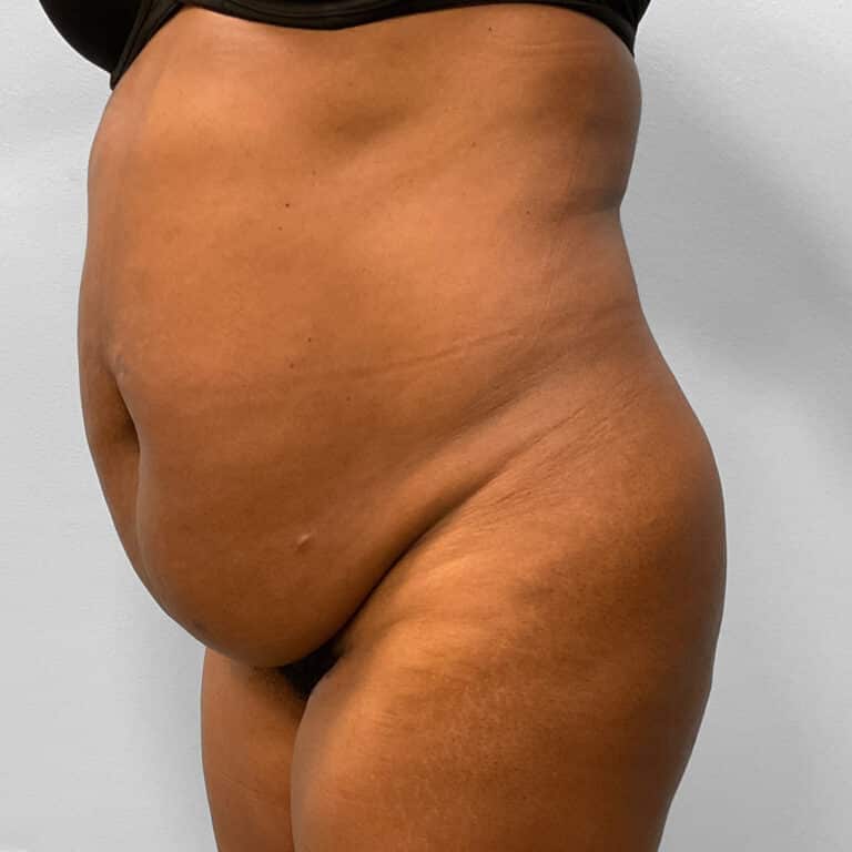 Before Image: BBL, Abdominoplasty & Lipo – Dr. Tucker - left-front-oblique