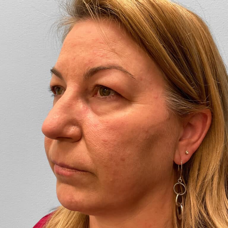 Before Image: Upper and Lower Blepharoplasty – Dr. Tucker - left-front-oblique