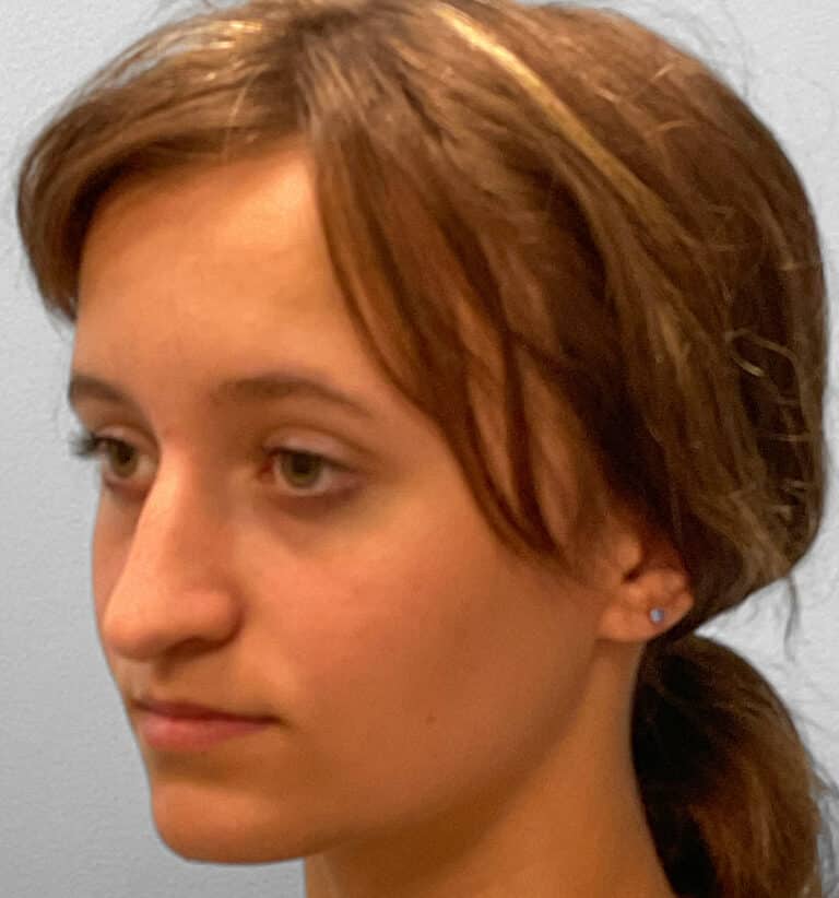 Before Image: Rhinoplasty – Dr. Tucker -