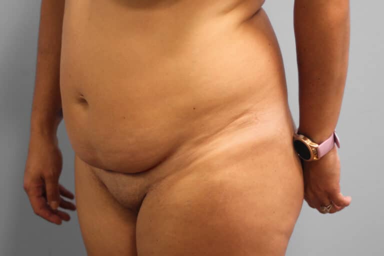 Before Image: Tummy Tuck – Dr. Tucker - left-front-oblique