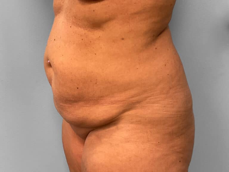 Before Image: Tummy Tuck & Lipo – Dr. Tucker - left-front-oblique