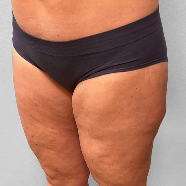 Before Image: Emsculpt Neo – Jessica - left-front-oblique