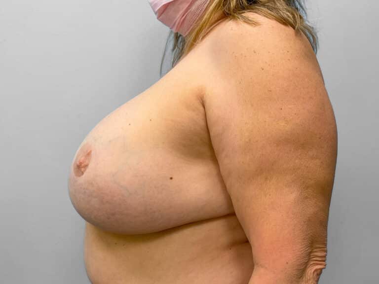 Before Image: Breast Lift & Implant Removal – Dr. Tucker - left-side