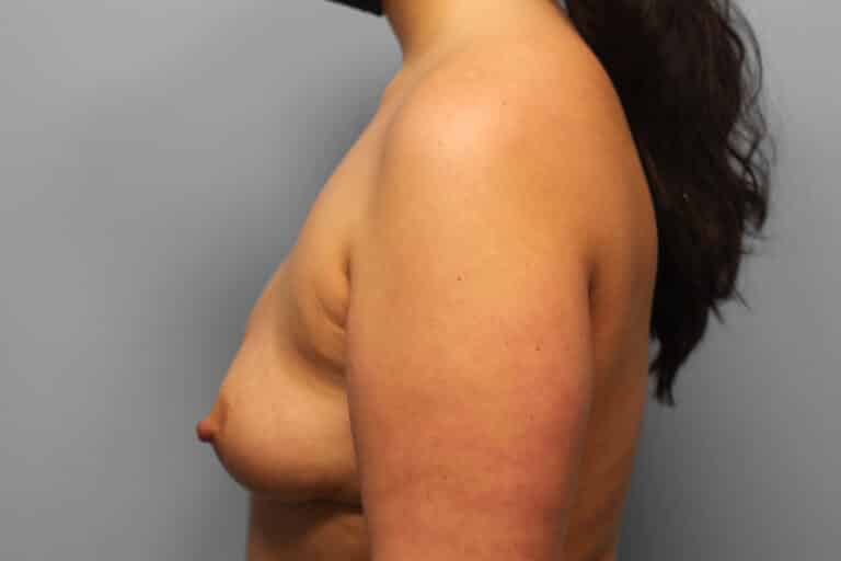 Before Image: Breast Augmentation – Dr. Tucker - left-side