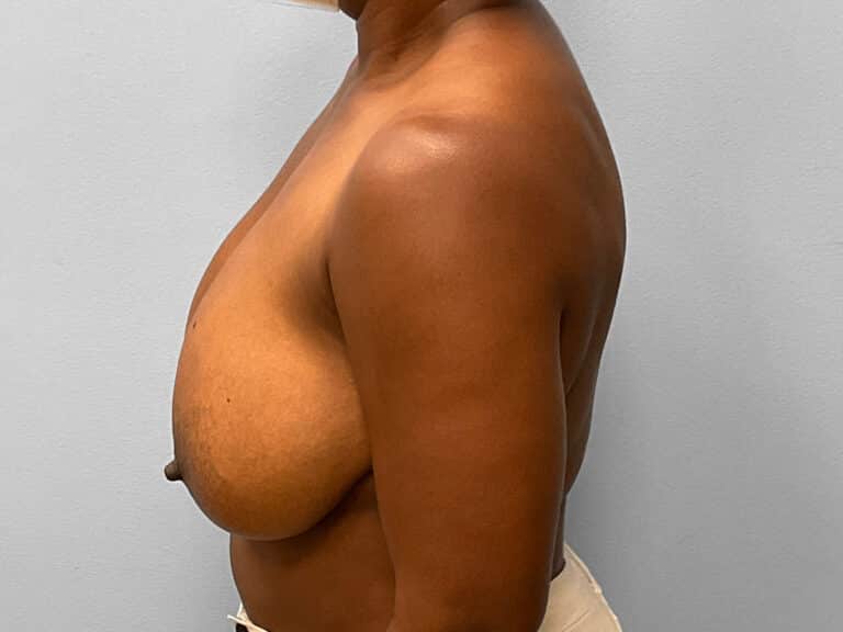Before Image: Breast Reduction – Dr. Tucker - left-side