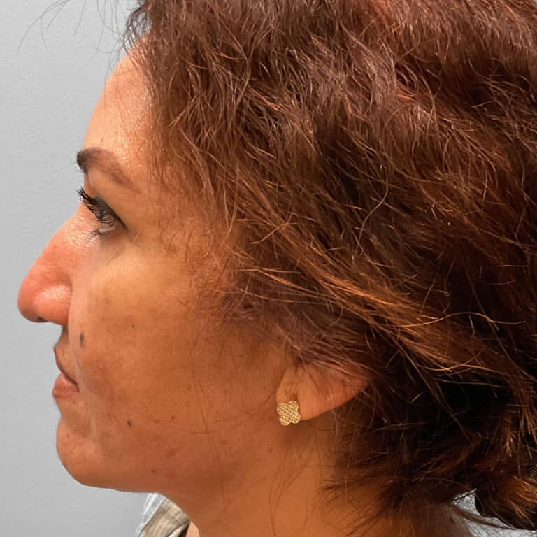 Before Image: Rhinoplasty – Dr. Tucker - left-side