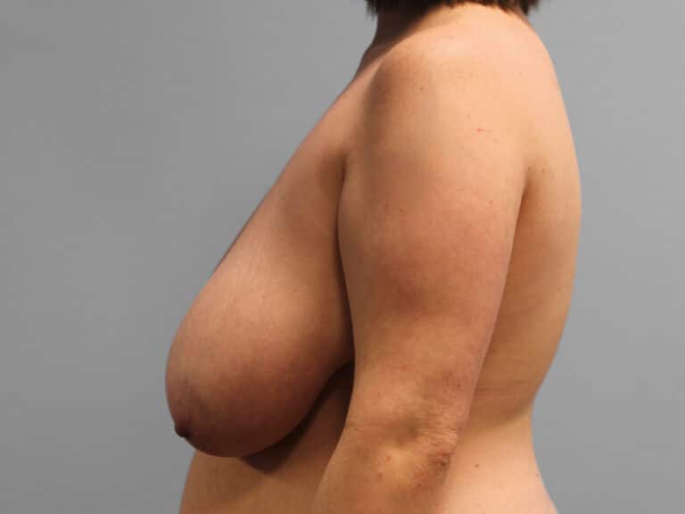 Before Image: Breast Reduction – Dr. Tucker - left-side