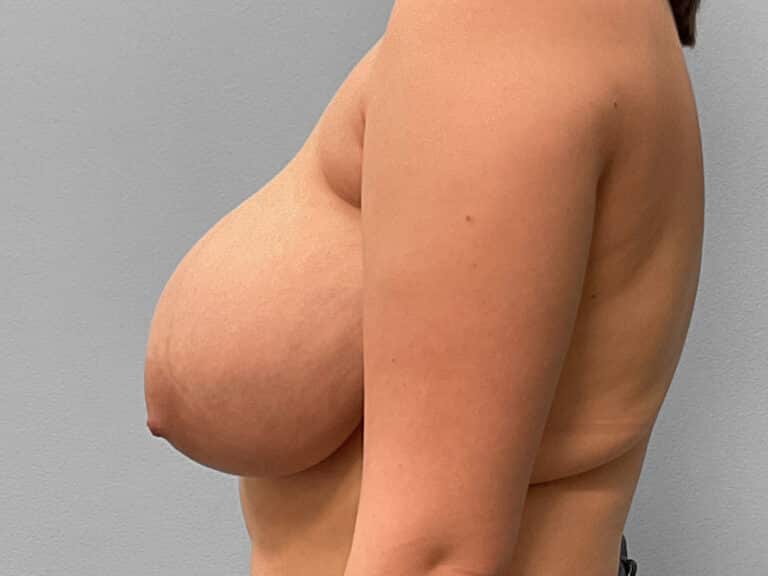 Before Image: Breast Reduction – Dr. Tucker - left-side