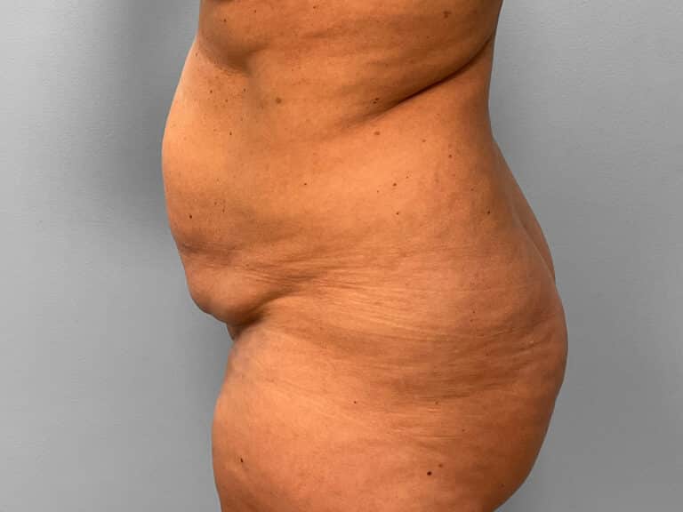 Before Image: Tummy Tuck & Lipo – Dr. Tucker - left-side