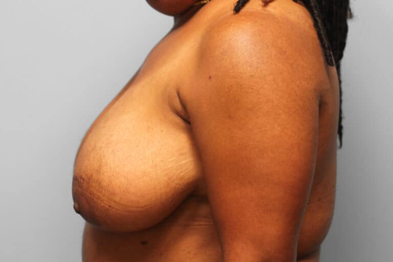 Before Image: Breast Reduction – Dr. Tucker - left-side