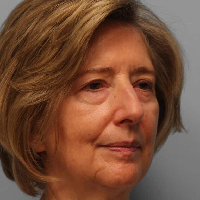 Before Image: Upper & Lower Blepharoplasty – Dr. Tucker - right-front-oblique