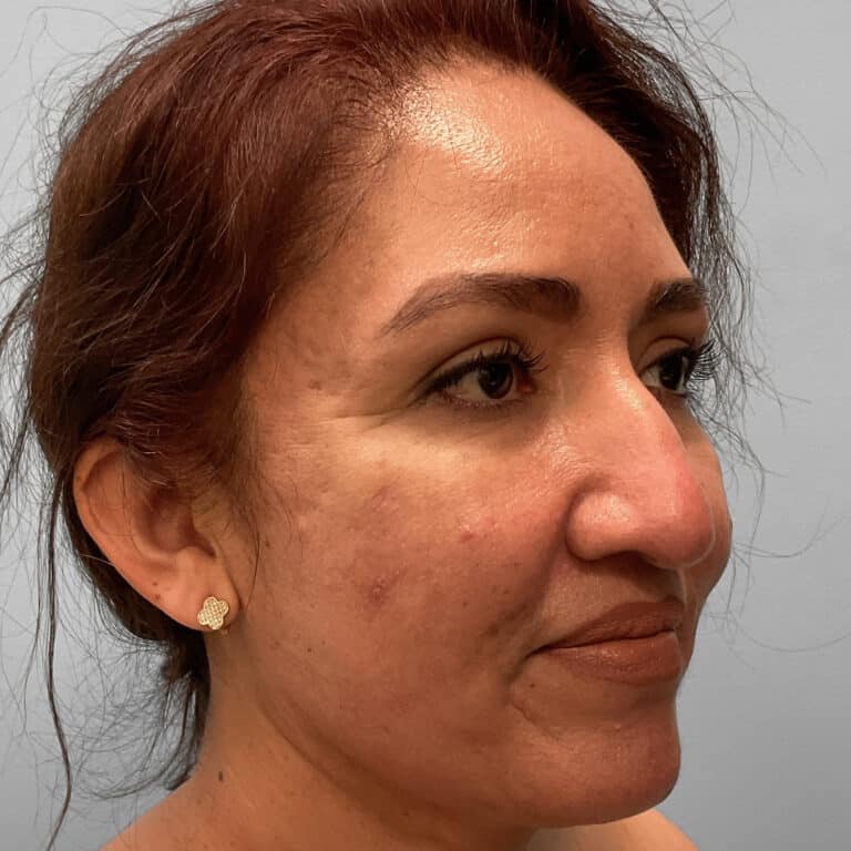 Before Image: Rhinoplasty – Dr. Tucker - right-front-oblique