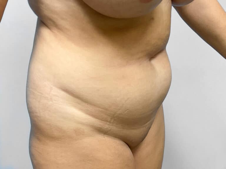 Before Image: Tummy Tuck & 360 Lipo – Dr. Tucker - right-front-oblique