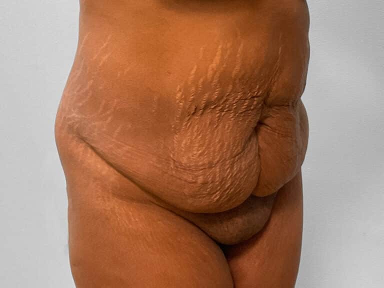 Before Image: Tummy Tuck & Lipo – Dr. Tucker - right-front-oblique