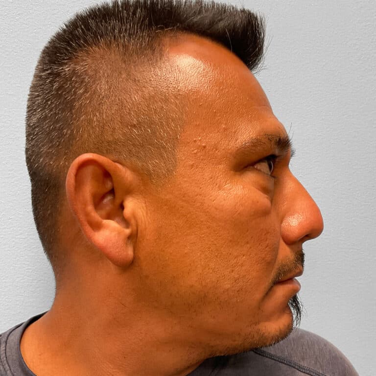 Before Image: Upper & Lower Blepharoplasty – Dr. Tucker - right-side
