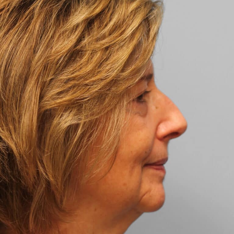 Before Image: Upper & Lower Blepharoplasty – Dr. Tucker - right-side
