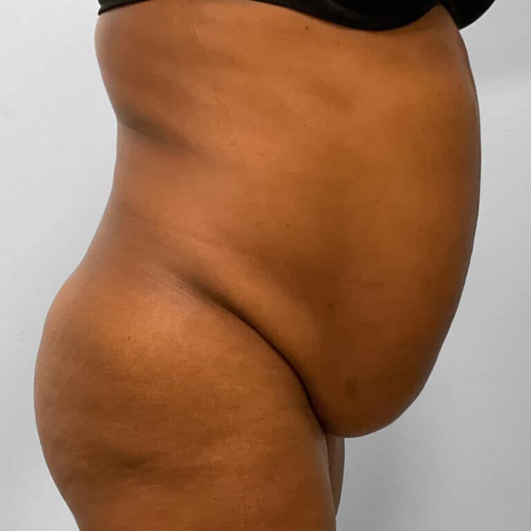 Before Image: BBL, Abdominoplasty & Lipo – Dr. Tucker - right-side