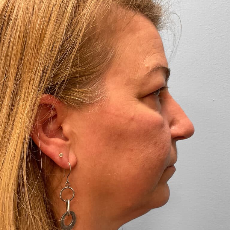 Before Image: Upper and Lower Blepharoplasty – Dr. Tucker - right-side
