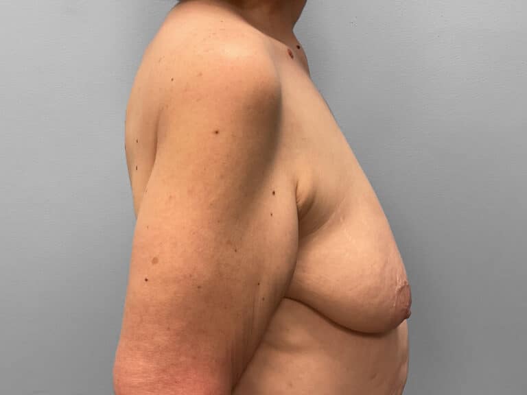 Before Image: Breast Augmentation & Lift – Dr. Tucker - right-side