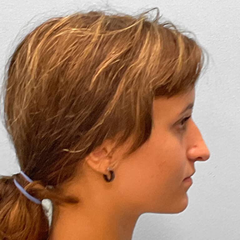 Before Image: Rhinoplasty – Dr. Tucker - right-side