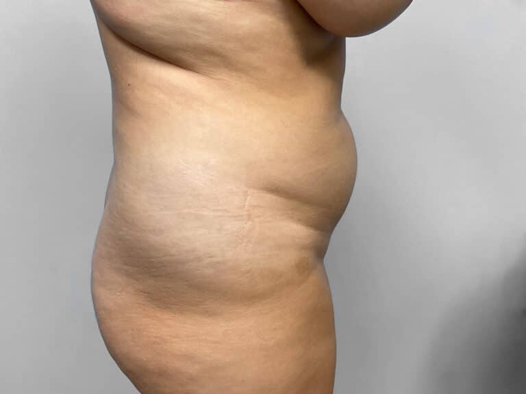 Before Image: Tummy Tuck & 360 Lipo – Dr. Tucker -