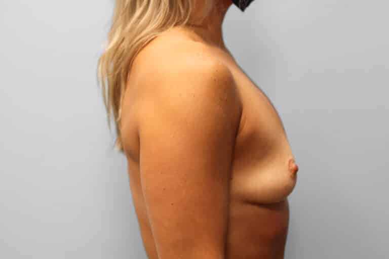 Before Image: Breast Augmentation – Dr. Tucker - right-side