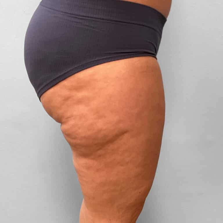 Before Image: Emsculpt Neo – Jessica - right-side