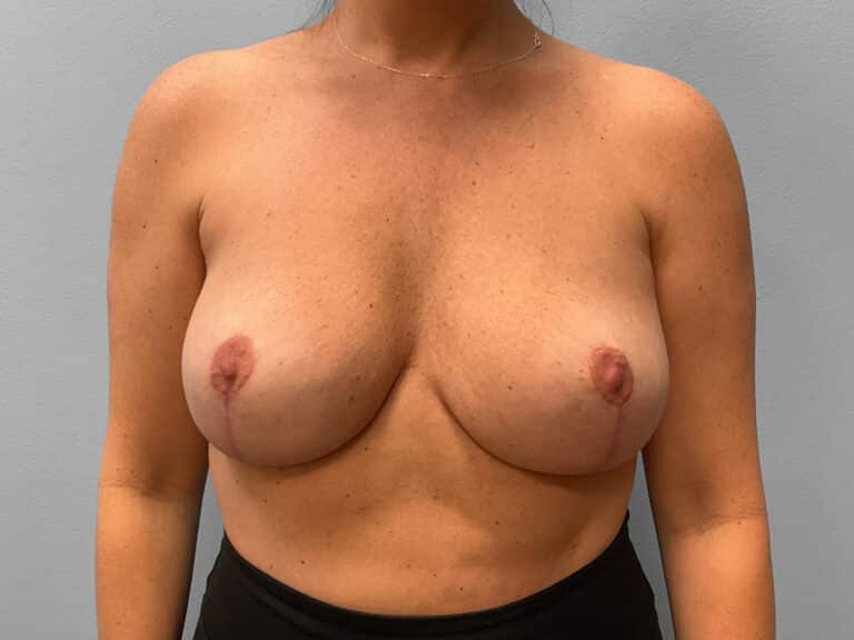 After Image: Breast Lift & Implant Removal – Dr. Tucker - front