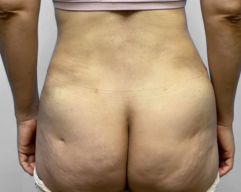 After Image: Tummy Tuck, BBL, & Lipo – Dr. Tucker - back