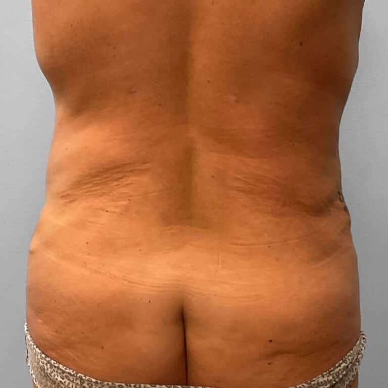 After Image: Tummy Tuck & Lipo – Dr. Tucker - back
