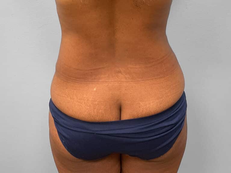 After Image: Tummy Tuck & Lipo – Dr. Tucker - back